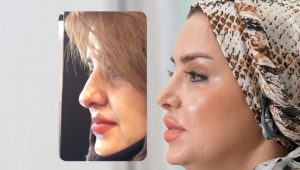 1 سال بعد از جراحی بینی گوشتی در مشهد